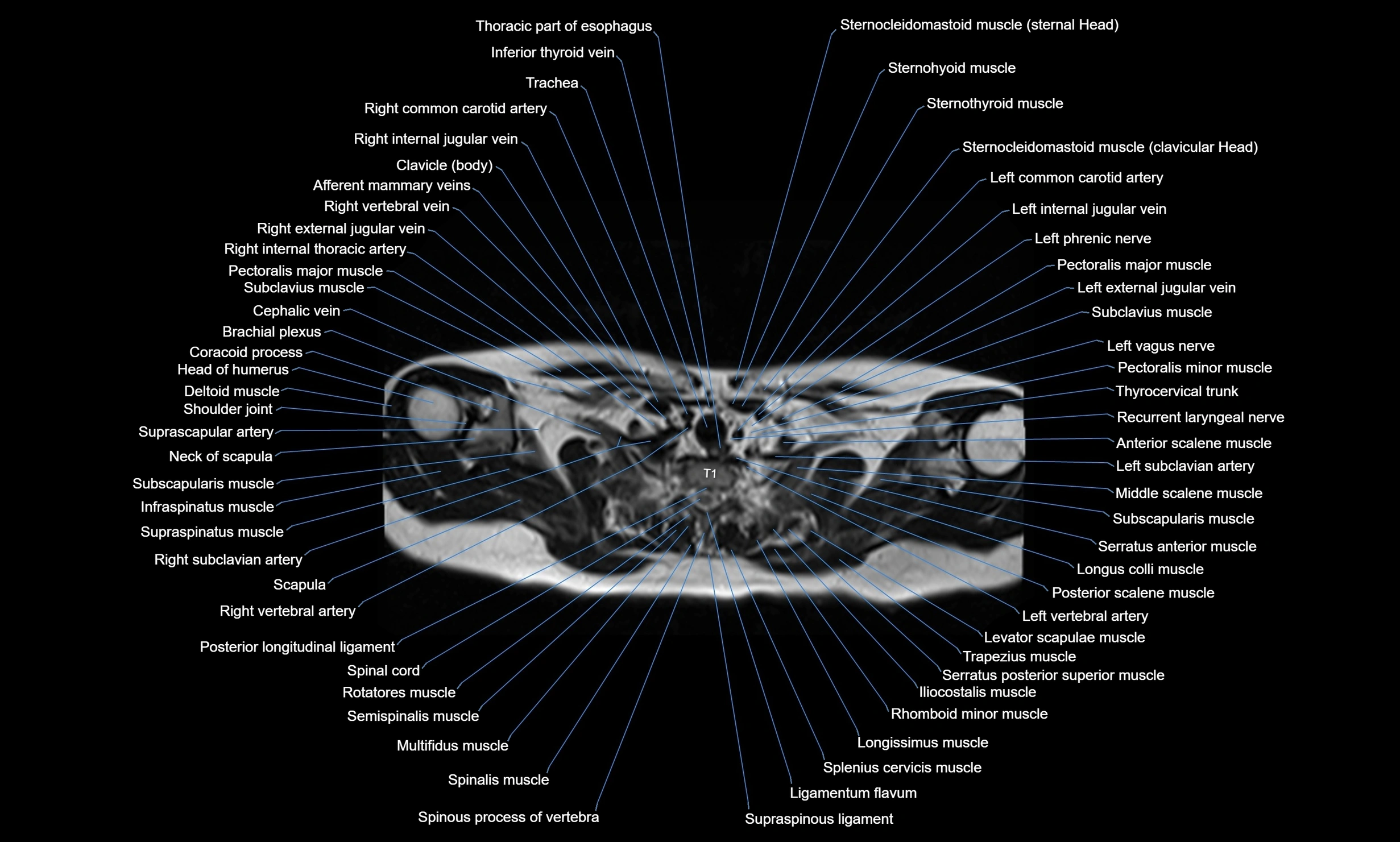 MRI chest axial  cross sectional anatomy 3T radiology  image-img-00001-00006.webp